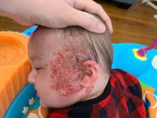 Can Babies Catch Cold Sores
