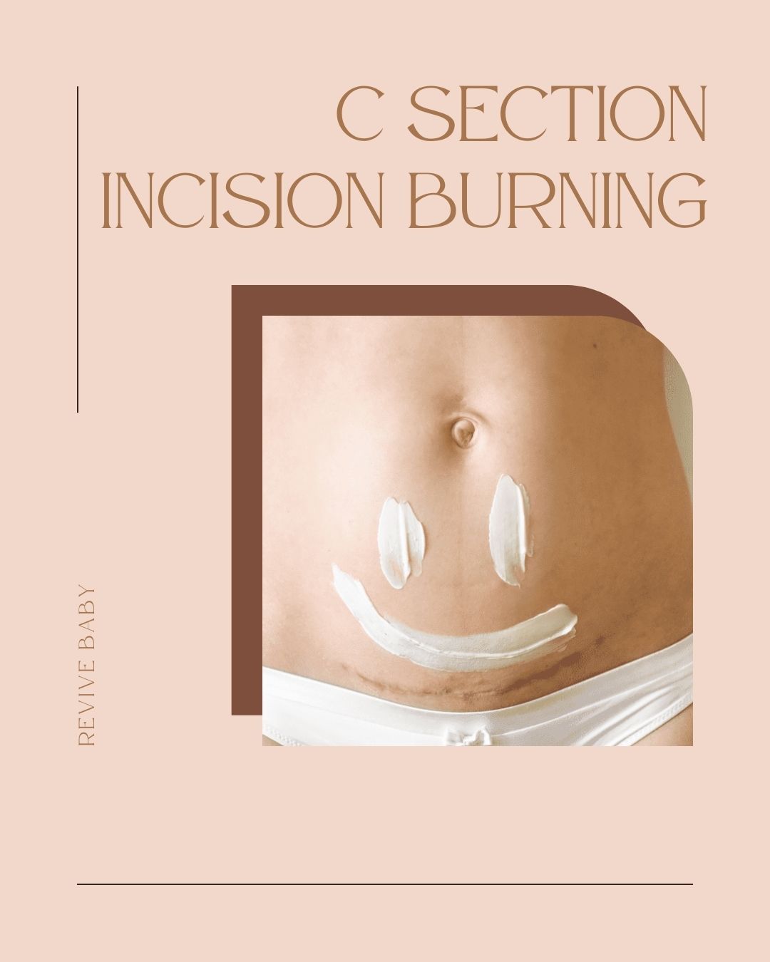 C Section Incision Burning